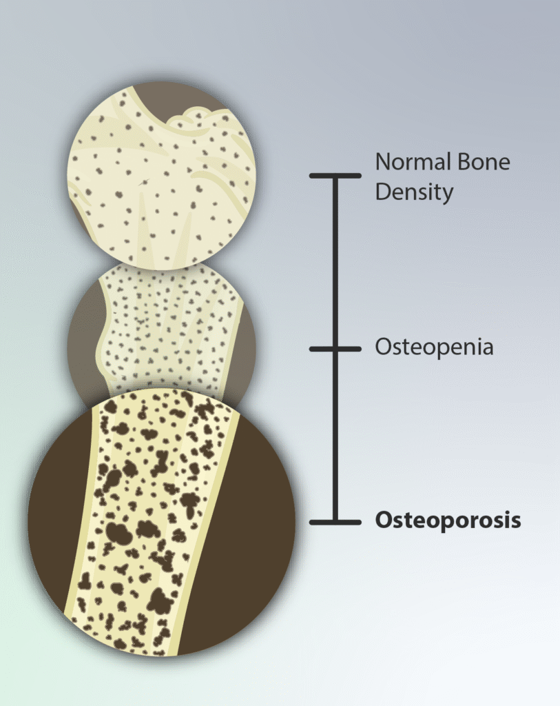 Osteoporosis: causes, symptoms & prevention depiction of an osteoporosis patient